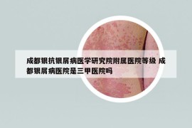 成都银抗银屑病医学研究院附属医院等级 成都银屑病医院是三甲医院吗