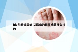 hiv引起银屑病 艾滋病的银屑病是什么样的