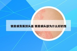 银屑病发展到头面 银屑病头部为什么好的慢