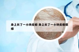 身上长了一小块皮癣 身上长了一小块皮癣很痒