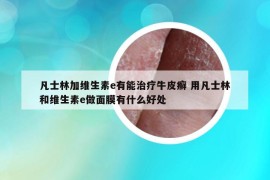 凡士林加维生素e有能治疗牛皮癣 用凡士林和维生素e做面膜有什么好处