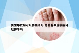 男生牛皮癣可以要孩子吗 男的有牛皮病癣可以怀孕吗