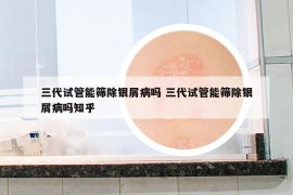 三代试管能筛除银屑病吗 三代试管能筛除银屑病吗知乎