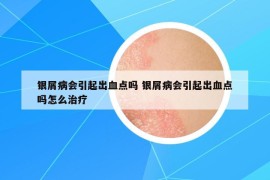 银屑病会引起出血点吗 银屑病会引起出血点吗怎么治疗