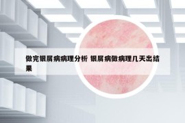 做完银屑病病理分析 银屑病做病理几天出结果