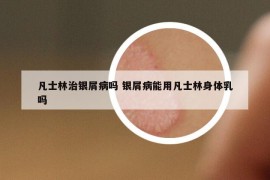 凡士林治银屑病吗 银屑病能用凡士林身体乳吗