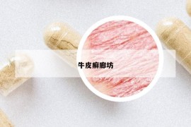 牛皮癣廊坊