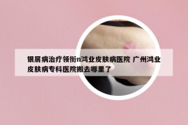 银屑病治疗领衔n鸿业皮肤病医院 广州鸿业皮肤病专科医院搬去哪里了