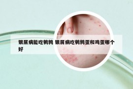 银屑病能吃鹌鹑 银屑病吃鹌鹑蛋和鸡蛋哪个好