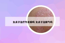 女贞子治疗牛皮癣吗 女贞子治脚气吗