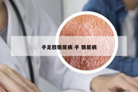 手足肢银屑病 手 银屑病