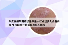 牛皮皮癣早期症状是不是小红点过多久会有白屑 牛皮肤癣开始是红点吗不掉皮
