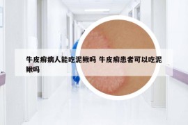 牛皮癣病人能吃泥鳅吗 牛皮癣患者可以吃泥鳅吗