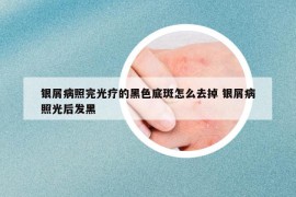 银屑病照完光疗的黑色底斑怎么去掉 银屑病照光后发黑