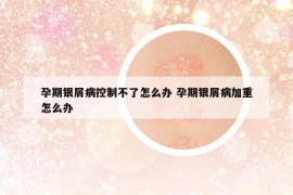 孕期银屑病控制不了怎么办 孕期银屑病加重怎么办