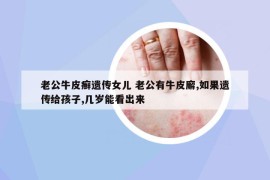 老公牛皮癣遗传女儿 老公有牛皮廨,如果遗传给孩子,几岁能看出来