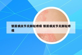 银屑病关节炎脚趾疼痒 银屑病关节炎脚趾疼痛