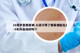 16周岁患银屑病 小孩子得了银屑病能在1~5年内自动好吗?!