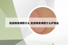 脸部银屑病擦什么 脸部银屑病擦什么护肤品