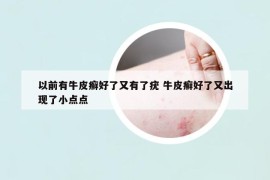 以前有牛皮癣好了又有了疣 牛皮癣好了又出现了小点点