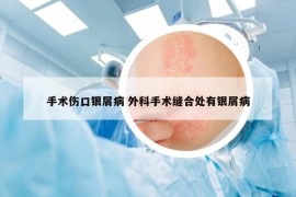 手术伤口银屑病 外科手术缝合处有银屑病