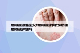 银屑颗粒价格是多少银屑颗粒的功效和作用 银屑颗粒有用吗
