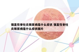 强直性脊柱炎银屑病是什么症状 强直性脊柱炎银屑病是什么症状图片