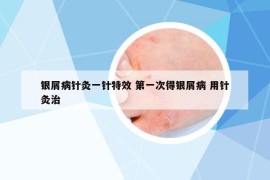 银屑病针灸一针特效 第一次得银屑病 用针灸治