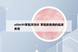 u88e99掌跖浓泡诊 掌跖脓疱病的临床表现