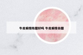 牛皮癣擦陈醋好吗 牛皮癣擦白醋
