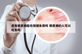 患有银屑病能吃保健鱼类吗 银屑病的人可以吃鱼吗