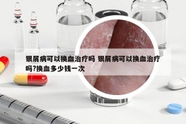 银屑病可以换血治疗吗 银屑病可以换血治疗吗?换血多少钱一次