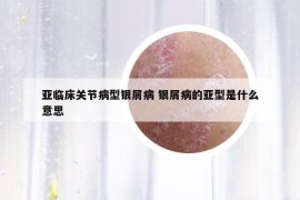 亚临床关节病型银屑病 银屑病的亚型是什么意思