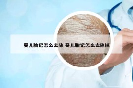 婴儿胎记怎么去除 婴儿胎记怎么去除掉