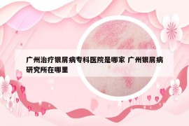 广州治疗银屑病专科医院是哪家 广州银屑病研究所在哪里