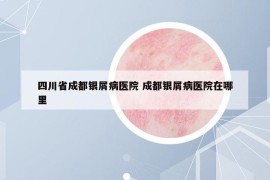 四川省成都银屑病医院 成都银屑病医院在哪里