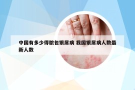 中国有多少得脓包银屑病 我国银屑病人数最新人数