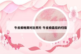 牛皮癣晚期对比照片 牛皮癣最后的归宿