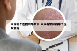 太原哪个医院有牛皮癣 太原看银屑病哪个医院最好