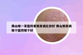 佛山哪一家医院看银屑病比较好 佛山银屑病哪个医院哪个好