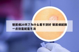 银屑病20天了为什么看不到好 银屑病就剩一点但是就是不消