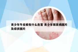 青少年牛皮癣有什么危害 青少年银屑病图片及症状图片