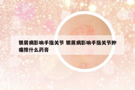 银屑病影响手指关节 银屑病影响手指关节肿痛擦什么药膏