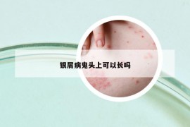 银屑病鬼头上可以长吗