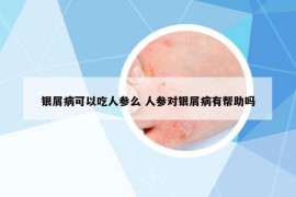银屑病可以吃人参么 人参对银屑病有帮助吗