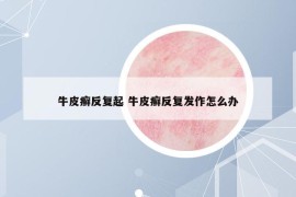 牛皮癣反复起 牛皮癣反复发作怎么办
