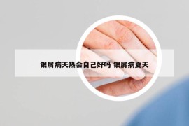 银屑病天热会自己好吗 银屑病夏天
