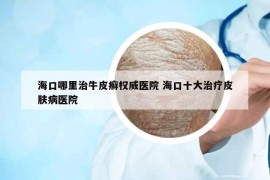 海口哪里治牛皮癣权威医院 海口十大治疗皮肤病医院