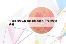 一周半宝宝头皮有银屑病怎么办 一岁半宝宝头癣