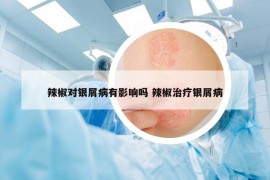 辣椒对银屑病有影响吗 辣椒治疗银屑病